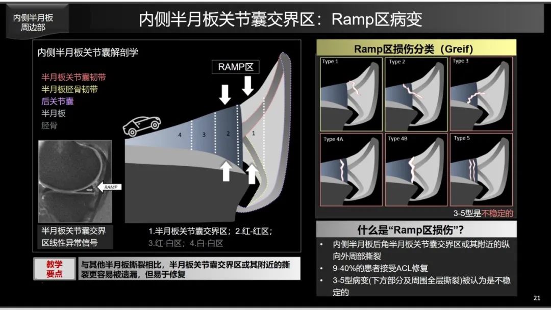 影像PPT - 【PPT】半月板根部,Ramp区,修复,及其后遗症-4 影像PPT - 【PPT】半月板根部,Ramp区,修复,及其后遗症-4