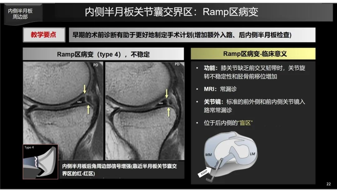 影像PPT - 【PPT】半月板根部,Ramp区,修复,及其后遗症-5 影像PPT - 【PPT】半月板根部,Ramp区,修复,及其后遗症-5