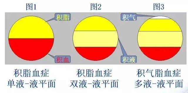 影像PPT - 积脂血症你是否还在报积液？-9