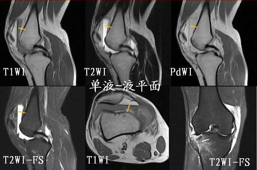 影像PPT - 积脂血症你是否还在报积液？-11