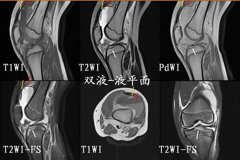 影像PPT - 积脂血症你是否还在报积液？-13