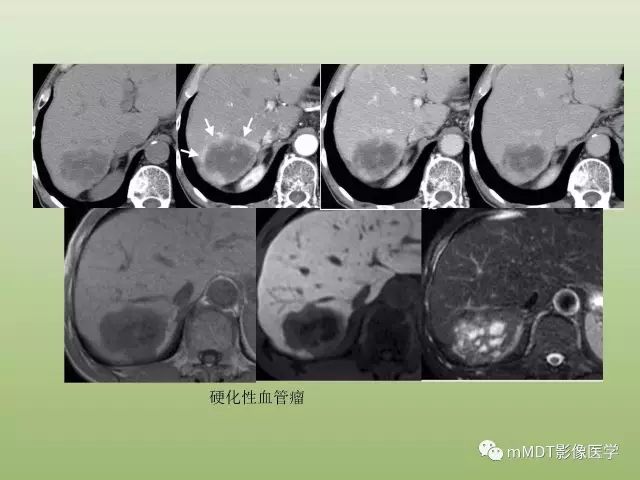 影像PPT - 【PPT】肝血管型疾病影像诊断（第一部分）-4