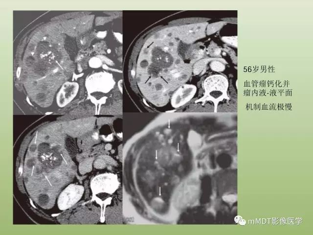影像PPT - 【PPT】肝血管型疾病影像诊断（第一部分）-8