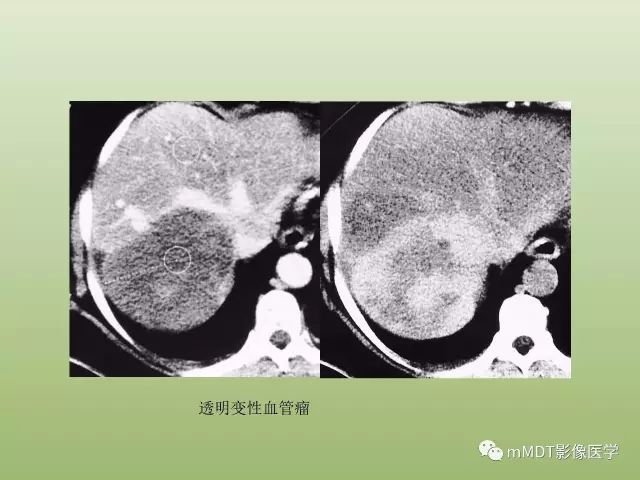 影像PPT - 【PPT】肝血管型疾病影像诊断（第一部分）-6