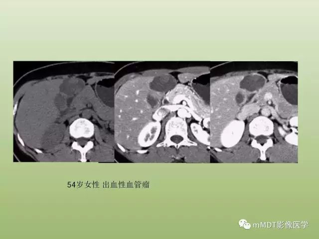 影像PPT - 【PPT】肝血管型疾病影像诊断（第一部分）-9