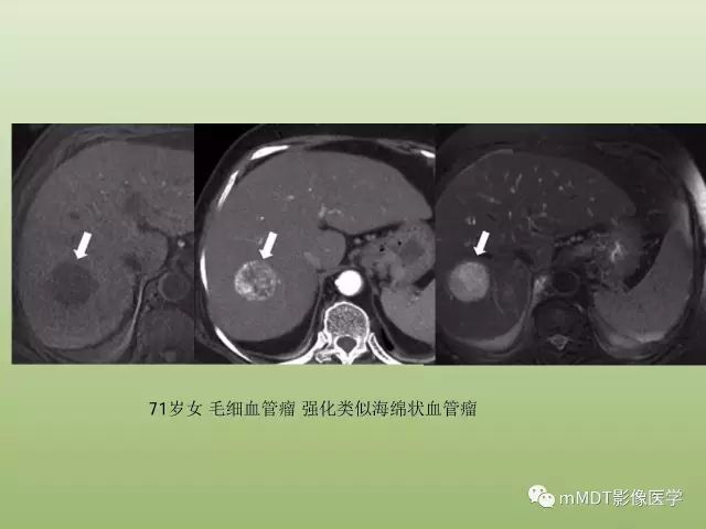 影像PPT - 【PPT】肝血管型疾病影像诊断（第一部分）-11