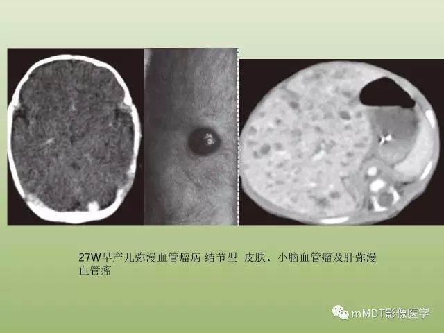 影像PPT - 【PPT】肝血管型疾病影像诊断（第一部分）-16
