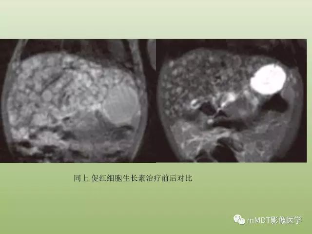 影像PPT - 【PPT】肝血管型疾病影像诊断（第一部分）-17