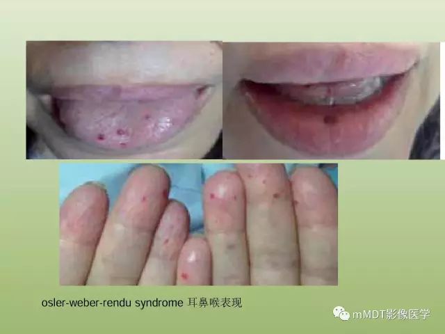 影像PPT - 【PPT】肝血管型疾病影像诊断（第一部分）-26