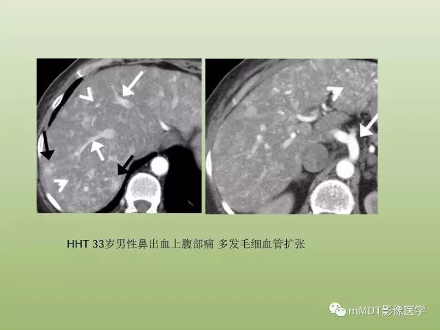 影像PPT - 【PPT】肝血管型疾病影像诊断（第一部分）-27