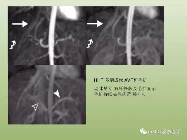 影像PPT - 【PPT】肝血管型疾病影像诊断（第一部分）-28
