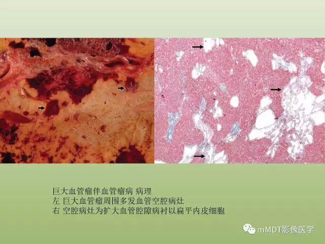 影像PPT - 【PPT】肝血管型疾病影像诊断（第一部分）-23
