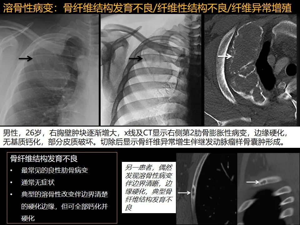 影像PPT - 【PPT】肋骨肿瘤、肿瘤样病变及获得性非创伤性病变的影像诊断基本思路-8 影像PPT - 【PPT】肋骨肿瘤、肿瘤样病变及获得性非创伤性病变的影像诊断基本思路-8