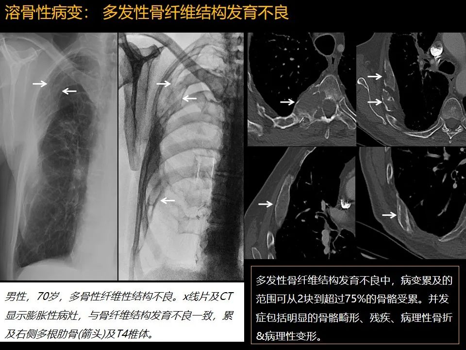 影像PPT - 【PPT】肋骨肿瘤、肿瘤样病变及获得性非创伤性病变的影像诊断基本思路-12 影像PPT - 【PPT】肋骨肿瘤、肿瘤样病变及获得性非创伤性病变的影像诊断基本思路-12
