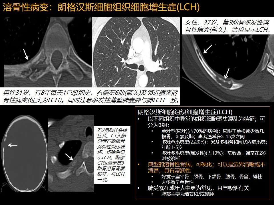影像PPT - 【PPT】肋骨肿瘤、肿瘤样病变及获得性非创伤性病变的影像诊断基本思路-14 影像PPT - 【PPT】肋骨肿瘤、肿瘤样病变及获得性非创伤性病变的影像诊断基本思路-14