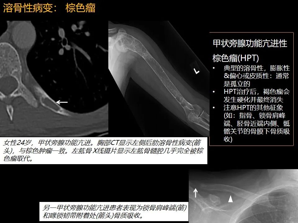 影像PPT - 【PPT】肋骨肿瘤、肿瘤样病变及获得性非创伤性病变的影像诊断基本思路-16 影像PPT - 【PPT】肋骨肿瘤、肿瘤样病变及获得性非创伤性病变的影像诊断基本思路-16