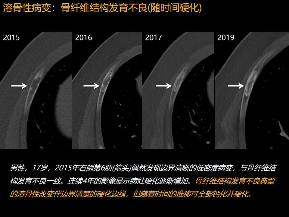 影像PPT - 【PPT】肋骨肿瘤、肿瘤样病变及获得性非创伤性病变的影像诊断基本思路-10 影像PPT - 【PPT】肋骨肿瘤、肿瘤样病变及获得性非创伤性病变的影像诊断基本思路-10