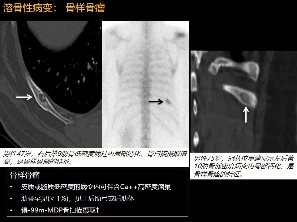 影像PPT - 【PPT】肋骨肿瘤、肿瘤样病变及获得性非创伤性病变的影像诊断基本思路-18 影像PPT - 【PPT】肋骨肿瘤、肿瘤样病变及获得性非创伤性病变的影像诊断基本思路-18