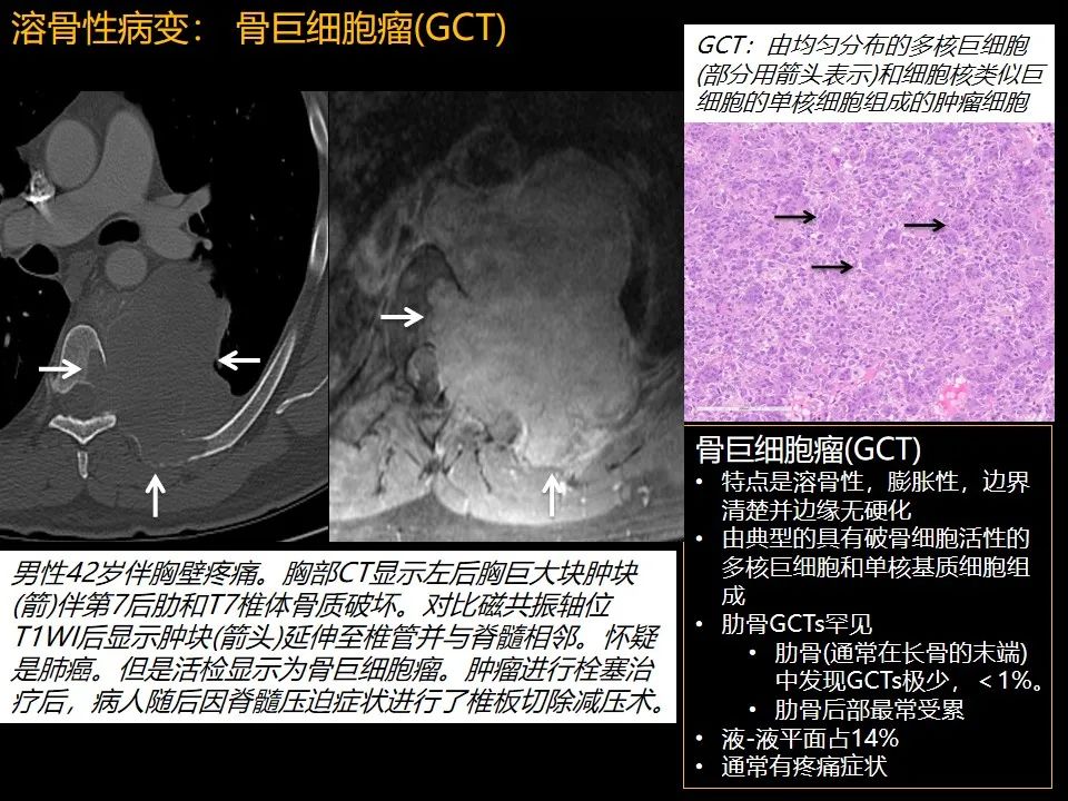 影像PPT - 【PPT】肋骨肿瘤、肿瘤样病变及获得性非创伤性病变的影像诊断基本思路-20 影像PPT - 【PPT】肋骨肿瘤、肿瘤样病变及获得性非创伤性病变的影像诊断基本思路-20