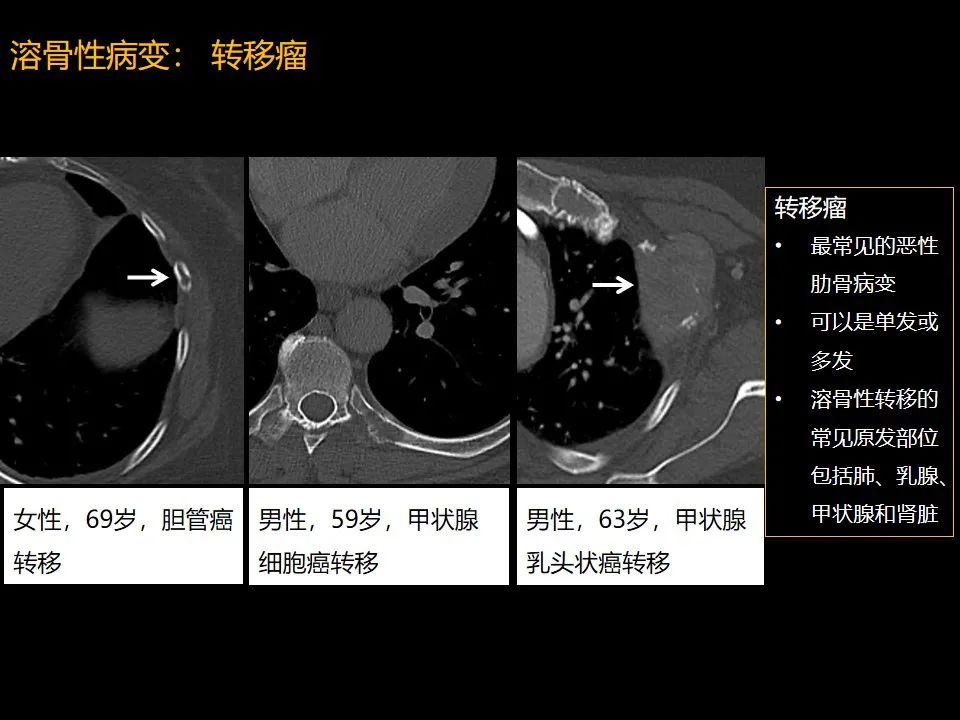 影像PPT - 【PPT】肋骨肿瘤、肿瘤样病变及获得性非创伤性病变的影像诊断基本思路-24 影像PPT - 【PPT】肋骨肿瘤、肿瘤样病变及获得性非创伤性病变的影像诊断基本思路-24