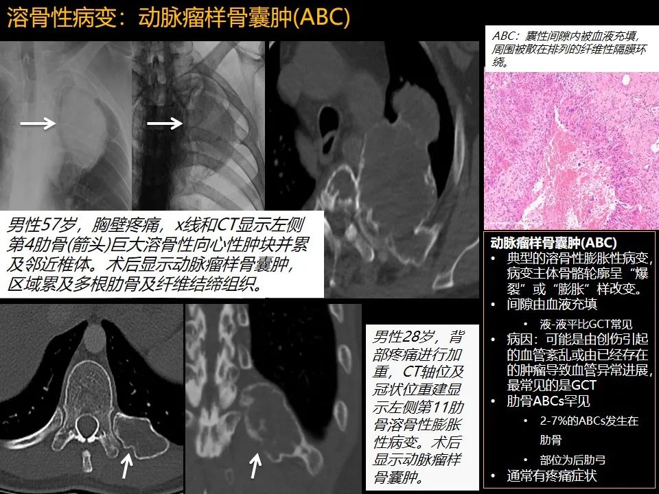 影像PPT - 【PPT】肋骨肿瘤、肿瘤样病变及获得性非创伤性病变的影像诊断基本思路-22 影像PPT - 【PPT】肋骨肿瘤、肿瘤样病变及获得性非创伤性病变的影像诊断基本思路-22