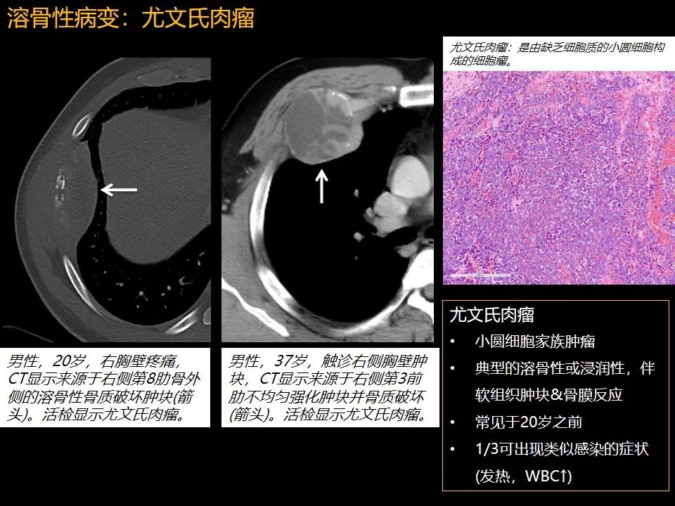 影像PPT - 【PPT】肋骨肿瘤、肿瘤样病变及获得性非创伤性病变的影像诊断基本思路-28 影像PPT - 【PPT】肋骨肿瘤、肿瘤样病变及获得性非创伤性病变的影像诊断基本思路-28