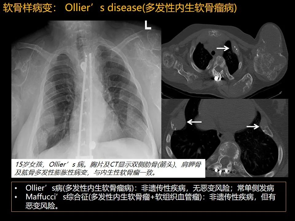 影像PPT - 【PPT】肋骨肿瘤、肿瘤样病变及获得性非创伤性病变的影像诊断基本思路-32 影像PPT - 【PPT】肋骨肿瘤、肿瘤样病变及获得性非创伤性病变的影像诊断基本思路-32
