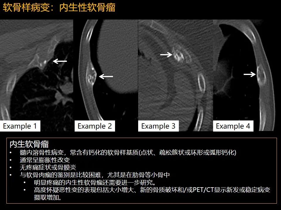 影像PPT - 【PPT】肋骨肿瘤、肿瘤样病变及获得性非创伤性病变的影像诊断基本思路-30 影像PPT - 【PPT】肋骨肿瘤、肿瘤样病变及获得性非创伤性病变的影像诊断基本思路-30