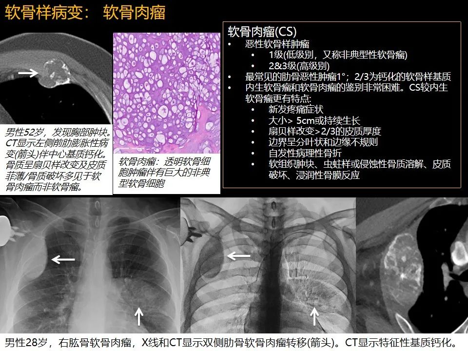 影像PPT - 【PPT】肋骨肿瘤、肿瘤样病变及获得性非创伤性病变的影像诊断基本思路-36 影像PPT - 【PPT】肋骨肿瘤、肿瘤样病变及获得性非创伤性病变的影像诊断基本思路-36