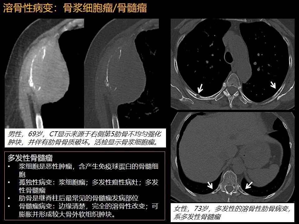影像PPT - 【PPT】肋骨肿瘤、肿瘤样病变及获得性非创伤性病变的影像诊断基本思路-26 影像PPT - 【PPT】肋骨肿瘤、肿瘤样病变及获得性非创伤性病变的影像诊断基本思路-26