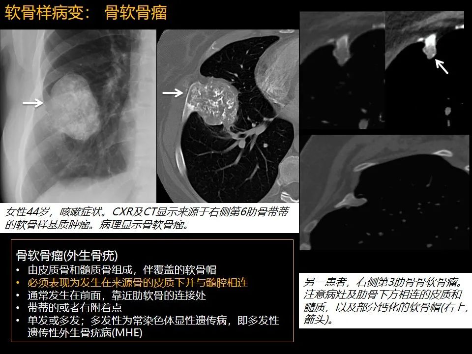 影像PPT - 【PPT】肋骨肿瘤、肿瘤样病变及获得性非创伤性病变的影像诊断基本思路-34 影像PPT - 【PPT】肋骨肿瘤、肿瘤样病变及获得性非创伤性病变的影像诊断基本思路-34