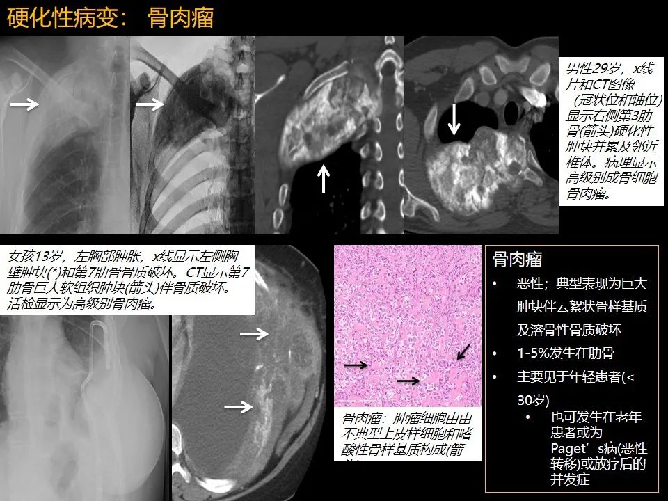 影像PPT - 【PPT】肋骨肿瘤、肿瘤样病变及获得性非创伤性病变的影像诊断基本思路-42 影像PPT - 【PPT】肋骨肿瘤、肿瘤样病变及获得性非创伤性病变的影像诊断基本思路-42