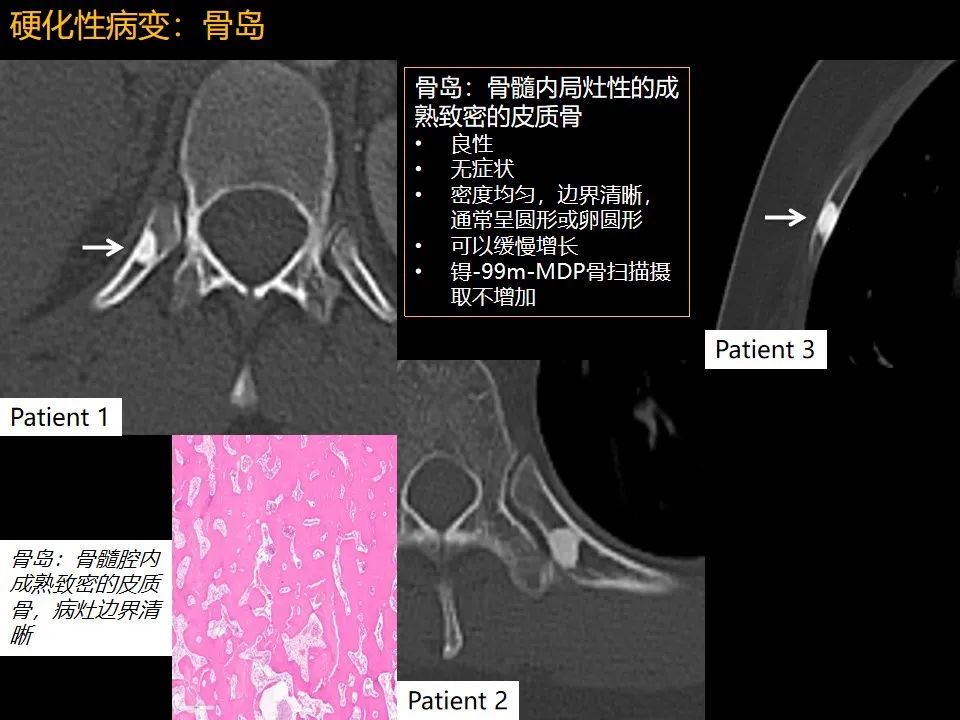 影像PPT - 【PPT】肋骨肿瘤、肿瘤样病变及获得性非创伤性病变的影像诊断基本思路-38 影像PPT - 【PPT】肋骨肿瘤、肿瘤样病变及获得性非创伤性病变的影像诊断基本思路-38
