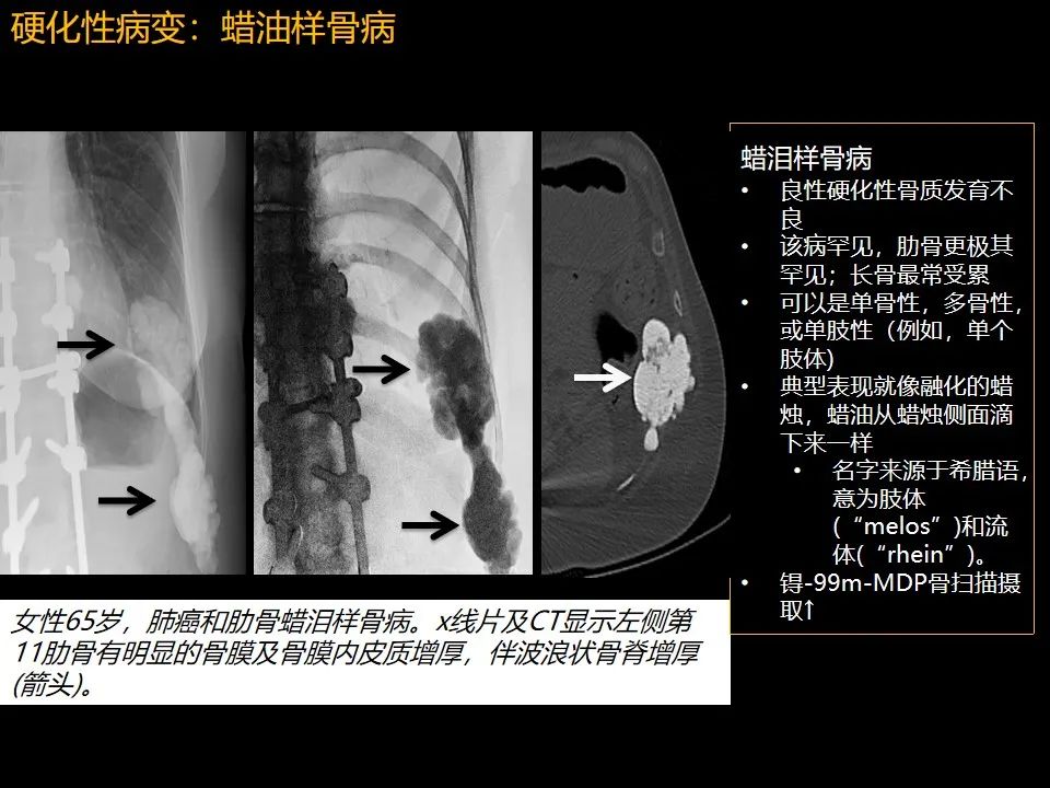 影像PPT - 【PPT】肋骨肿瘤、肿瘤样病变及获得性非创伤性病变的影像诊断基本思路-44 影像PPT - 【PPT】肋骨肿瘤、肿瘤样病变及获得性非创伤性病变的影像诊断基本思路-44