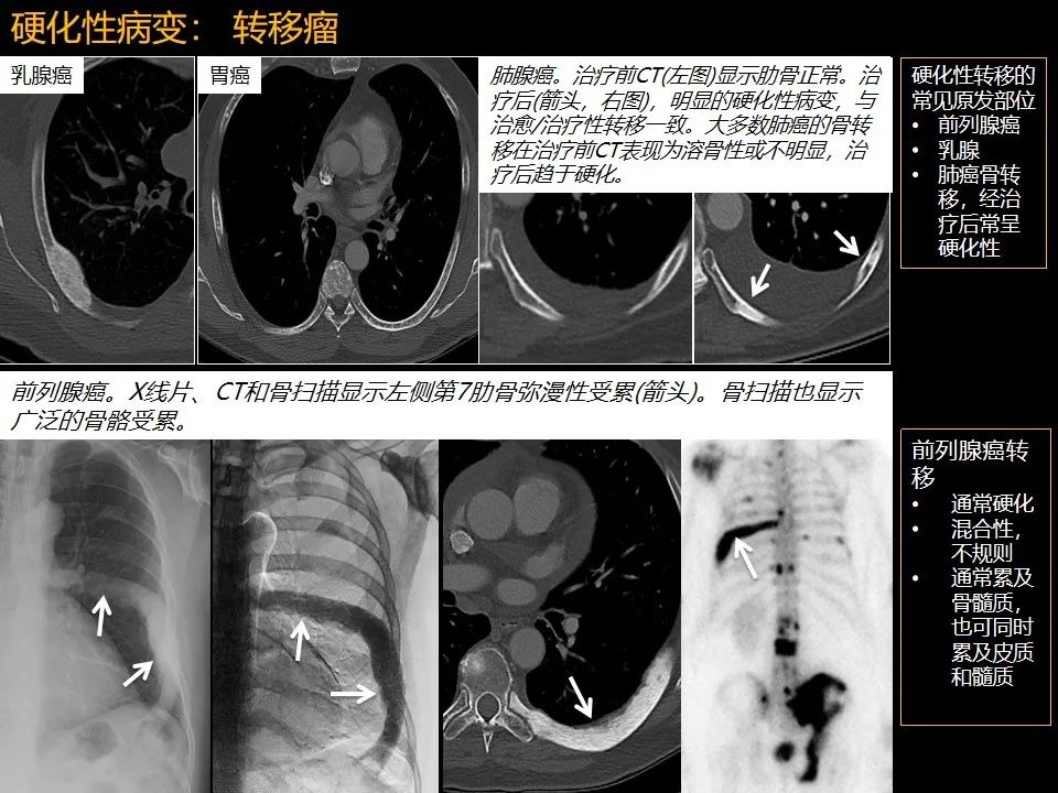 影像PPT - 【PPT】肋骨肿瘤、肿瘤样病变及获得性非创伤性病变的影像诊断基本思路-40 影像PPT - 【PPT】肋骨肿瘤、肿瘤样病变及获得性非创伤性病变的影像诊断基本思路-40