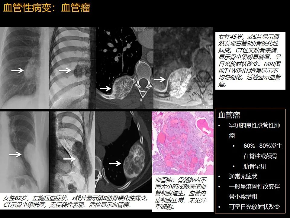 影像PPT - 【PPT】肋骨肿瘤、肿瘤样病变及获得性非创伤性病变的影像诊断基本思路-46 影像PPT - 【PPT】肋骨肿瘤、肿瘤样病变及获得性非创伤性病变的影像诊断基本思路-46