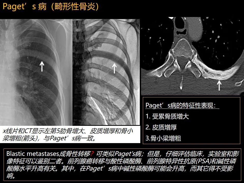 影像PPT - 【PPT】肋骨肿瘤、肿瘤样病变及获得性非创伤性病变的影像诊断基本思路-48 影像PPT - 【PPT】肋骨肿瘤、肿瘤样病变及获得性非创伤性病变的影像诊断基本思路-48