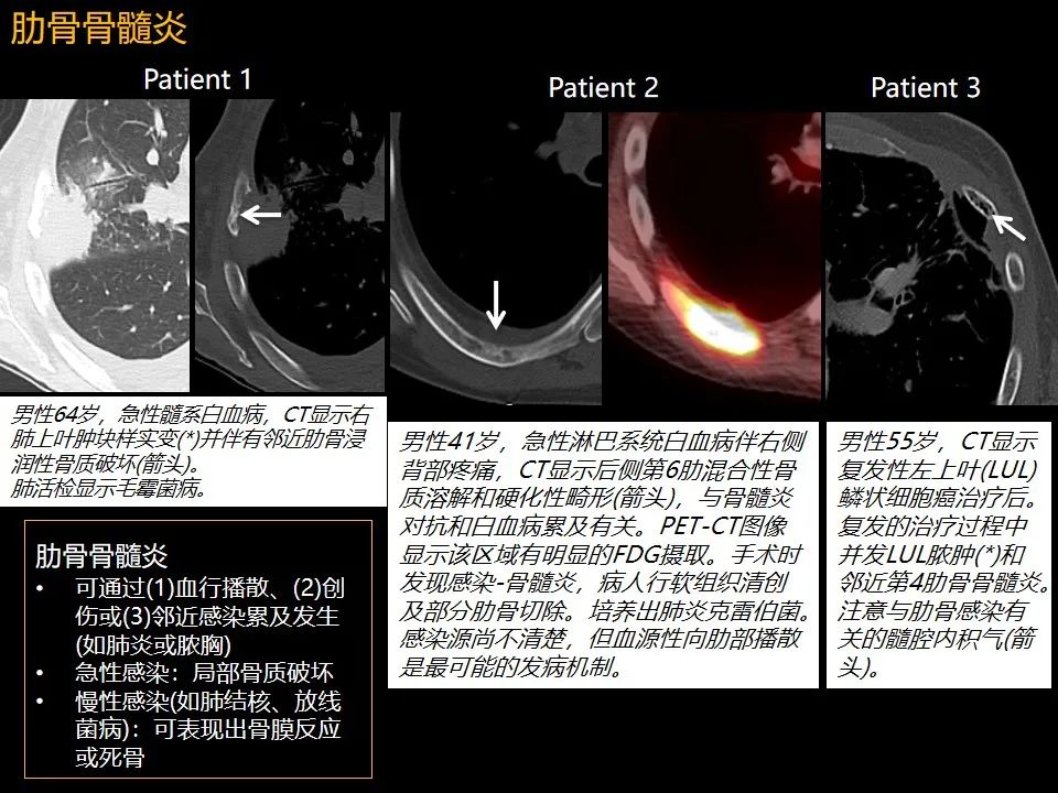 影像PPT - 【PPT】肋骨肿瘤、肿瘤样病变及获得性非创伤性病变的影像诊断基本思路-50 影像PPT - 【PPT】肋骨肿瘤、肿瘤样病变及获得性非创伤性病变的影像诊断基本思路-50