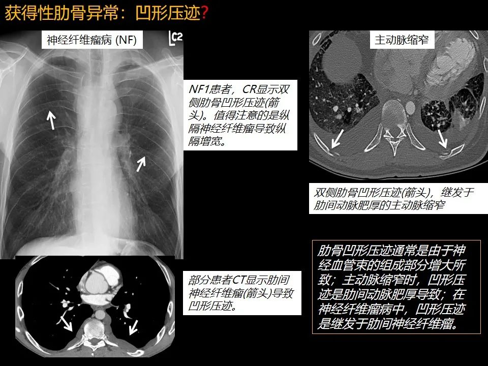 影像PPT - 【PPT】肋骨肿瘤、肿瘤样病变及获得性非创伤性病变的影像诊断基本思路-52 影像PPT - 【PPT】肋骨肿瘤、肿瘤样病变及获得性非创伤性病变的影像诊断基本思路-52