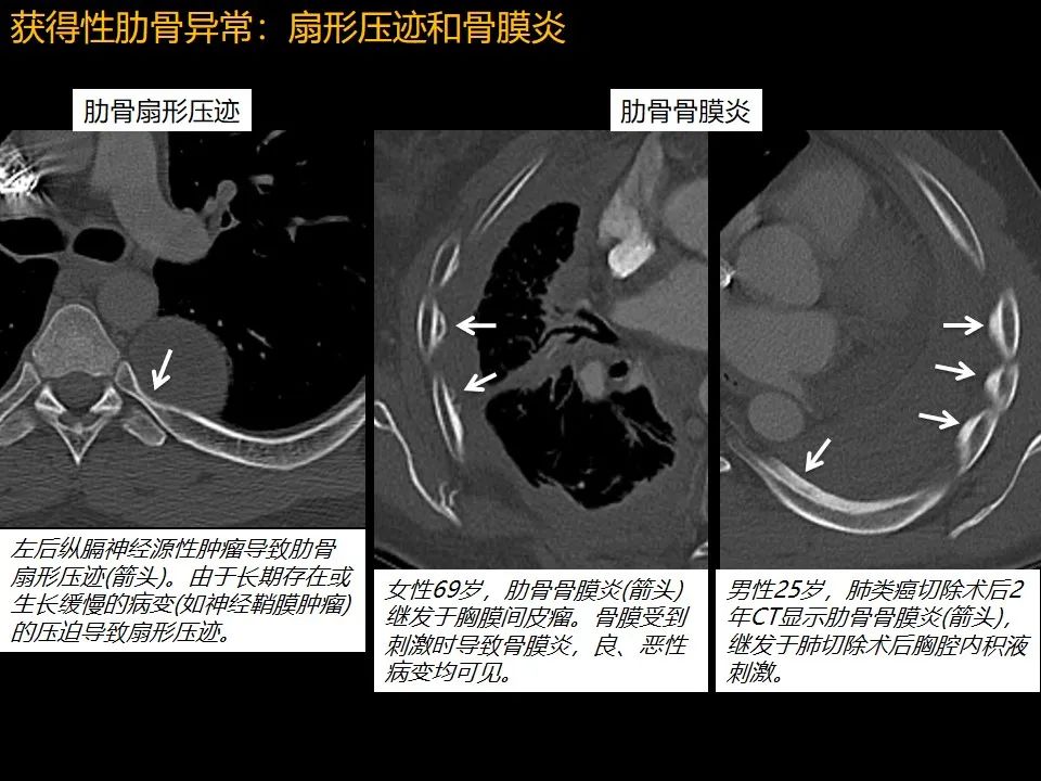 影像PPT - 【PPT】肋骨肿瘤、肿瘤样病变及获得性非创伤性病变的影像诊断基本思路-54 影像PPT - 【PPT】肋骨肿瘤、肿瘤样病变及获得性非创伤性病变的影像诊断基本思路-54