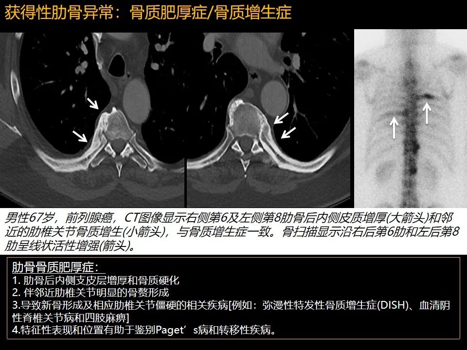 影像PPT - 【PPT】肋骨肿瘤、肿瘤样病变及获得性非创伤性病变的影像诊断基本思路-58 影像PPT - 【PPT】肋骨肿瘤、肿瘤样病变及获得性非创伤性病变的影像诊断基本思路-58