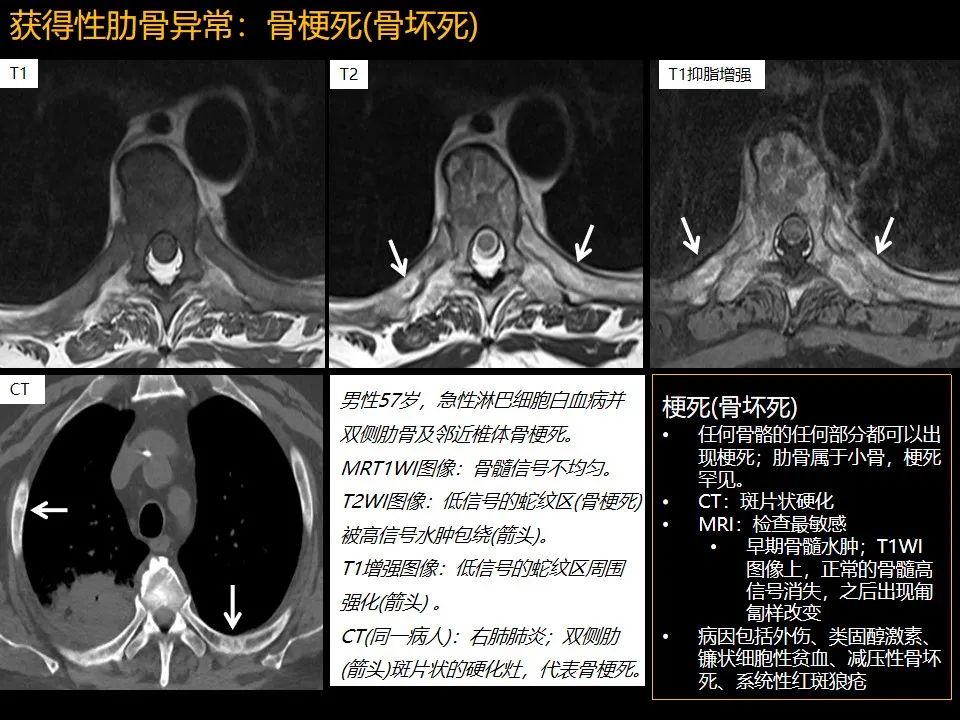 影像PPT - 【PPT】肋骨肿瘤、肿瘤样病变及获得性非创伤性病变的影像诊断基本思路-60 影像PPT - 【PPT】肋骨肿瘤、肿瘤样病变及获得性非创伤性病变的影像诊断基本思路-60