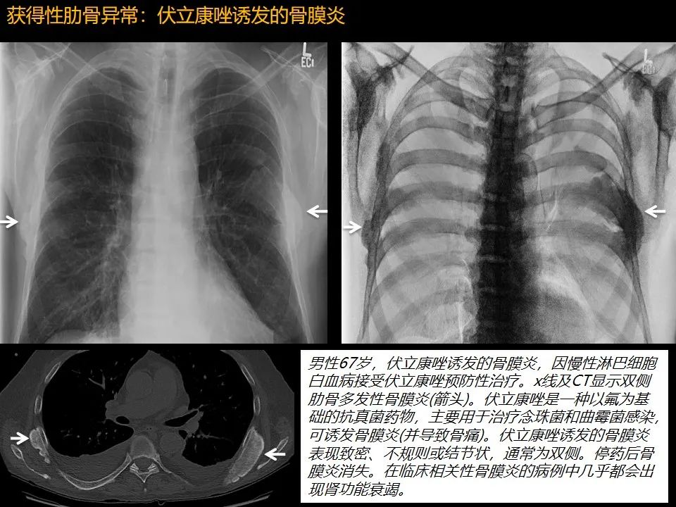 影像PPT - 【PPT】肋骨肿瘤、肿瘤样病变及获得性非创伤性病变的影像诊断基本思路-56 影像PPT - 【PPT】肋骨肿瘤、肿瘤样病变及获得性非创伤性病变的影像诊断基本思路-56