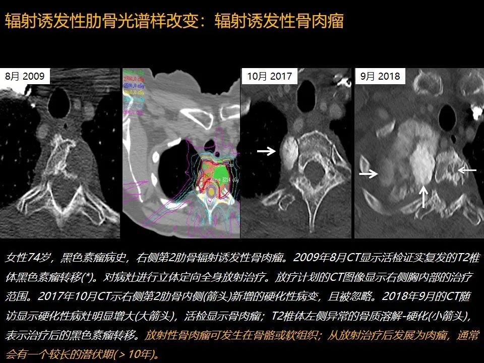 影像PPT - 【PPT】肋骨肿瘤、肿瘤样病变及获得性非创伤性病变的影像诊断基本思路-64 影像PPT - 【PPT】肋骨肿瘤、肿瘤样病变及获得性非创伤性病变的影像诊断基本思路-64