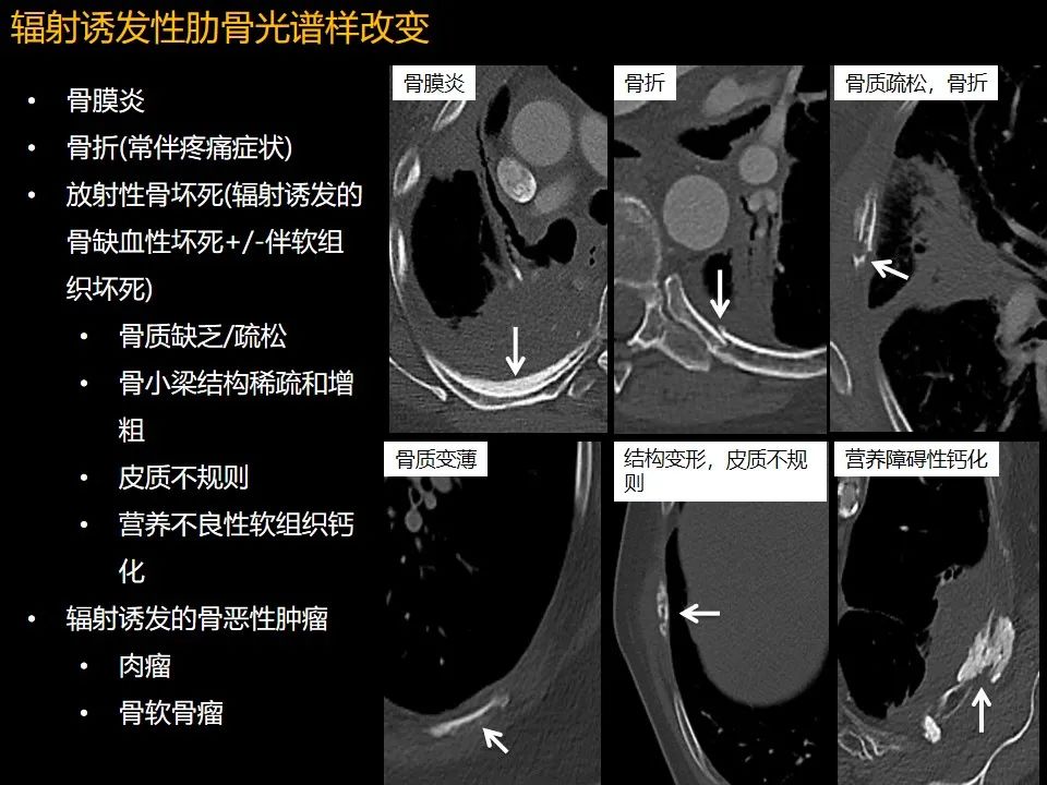 影像PPT - 【PPT】肋骨肿瘤、肿瘤样病变及获得性非创伤性病变的影像诊断基本思路-62 影像PPT - 【PPT】肋骨肿瘤、肿瘤样病变及获得性非创伤性病变的影像诊断基本思路-62