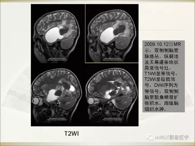 影像PPT - 【PPT】幼年黄色肉芽肿-9