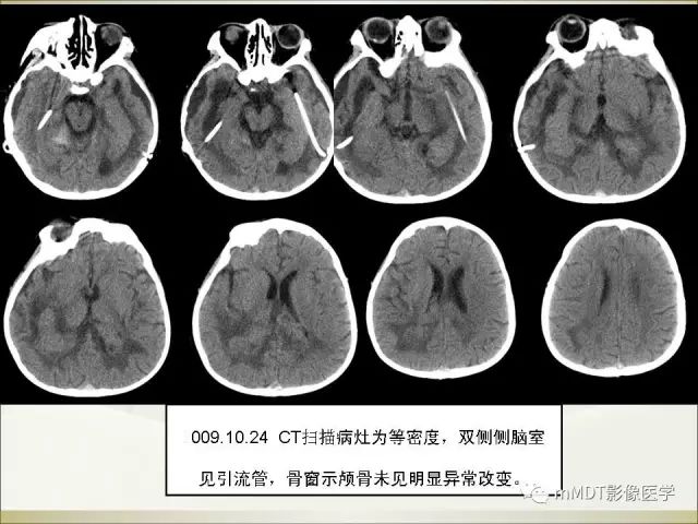 影像PPT - 【PPT】幼年黄色肉芽肿-10