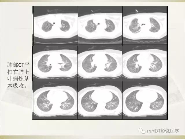 影像PPT - 【PPT】幼年黄色肉芽肿-16