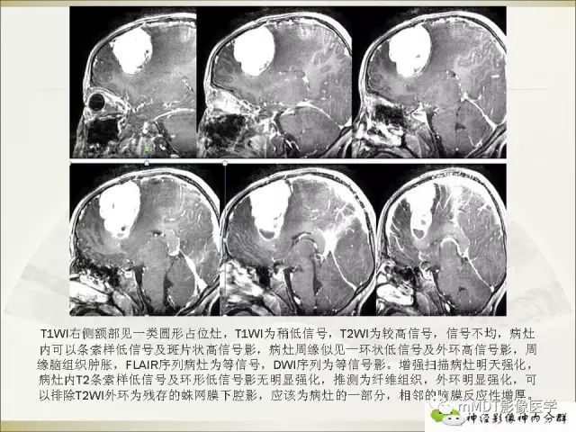影像PPT - 【PPT】幼年黄色肉芽肿-23