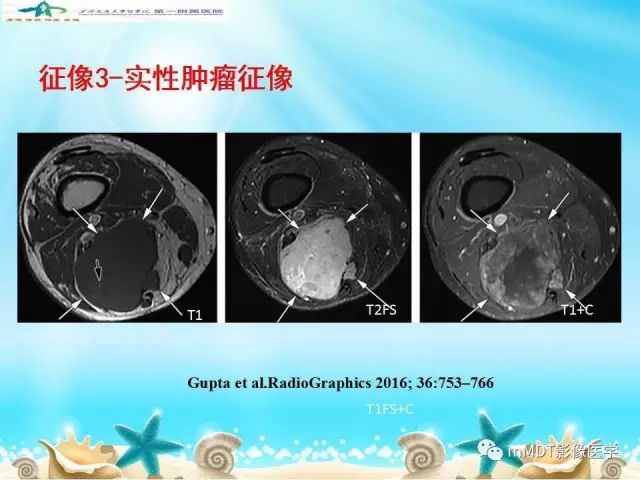 影像PPT - 【PPT】黏液样软组织肿瘤影像学-4
